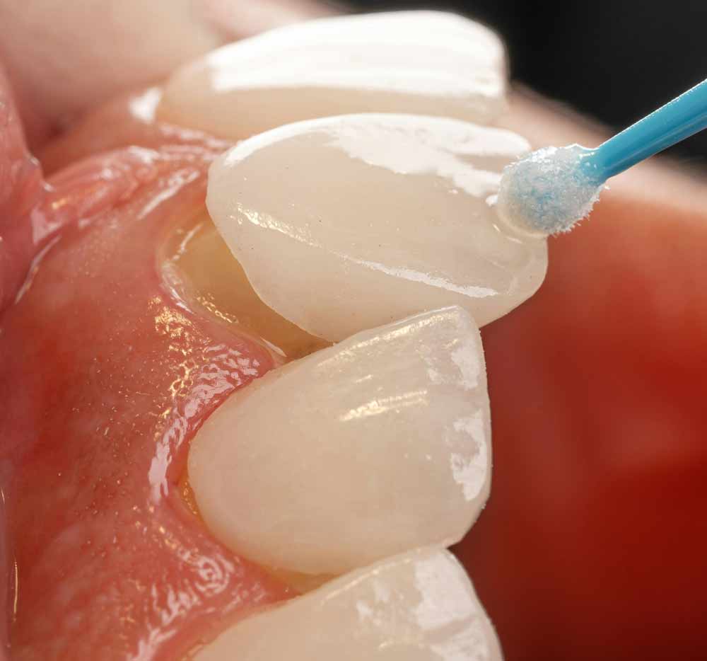 Porcelain vs. composite veneers—close-up of dental veneers being applied and refined, illustrating cosmetic dentistry techniques used to enhance tooth appearance, improve symmetry, and help patients choose the best option for a long-lasting, natural-looking smile.
